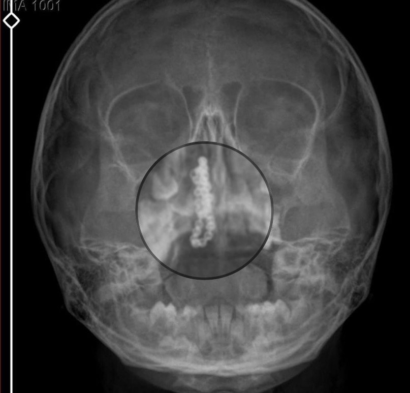 5 yaşındaki Polen, 2 yıldır burnunda tırnak makası zinciriyle yaşamış