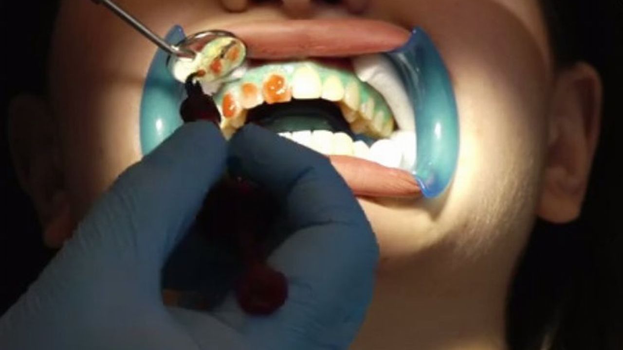 Diş beyazlatmak dişlere zarar verir mi