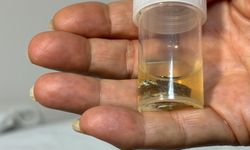 Alüminyum kabıyla yuttuğu hap, 4 yıl sonra akciğerinden çıkarıldı