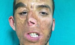 İlk yüz nakilli Uğur Acar, hayata 14 yıldır başka bir yüzle bakıyor