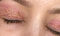 Güzellik salonundaki işlem sonrası gözünde hasar iddiasıyla yaptığı şikayet reddedildi; 'Uzmanına gidin' uyarısı yaptı