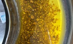 Karın ağrısı şikayetiyle gittiği hastanede safra kesesinden 2 bin 67 taş çıkarıldı