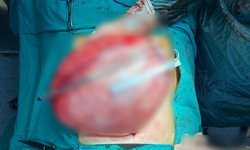 Kilolarından kurtulmak için doktora giden liseli kızın karnından 3,5 kilo ağırlığında kist çıktı