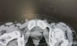 Midelerinde uyuşturucuyla yakalanan 2 şüpheli tutuklandı