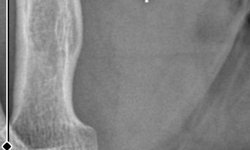 Yanlış tedavi sonrası parmağının ampute edildiği ve kolunda metal cisim unutulduğu iddiası