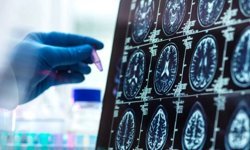 Araştırma: Alzheimer düşünüldüğünden daha erken başlayabilir