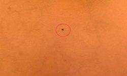 7 yaşındaki Mustafa'nın göğsüne kene yapıştı