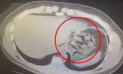 Midesinden 76 parça halinde 571 gram metamfetamin çıkarıldı