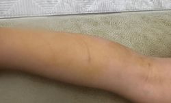 Sokak köpeğinin saldırısına uğrayan Erva yaralandı