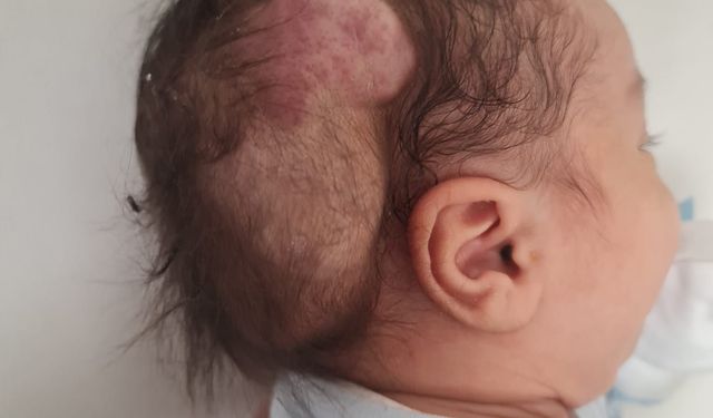 Talha bebeğin dünyada nadir görülen beyin tümörü, 4 saatlik operasyonla alındı