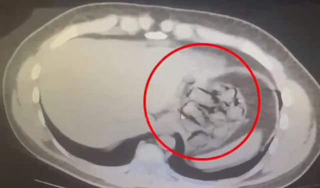 Midesinden 76 parça halinde 571 gram metamfetamin çıkarıldı