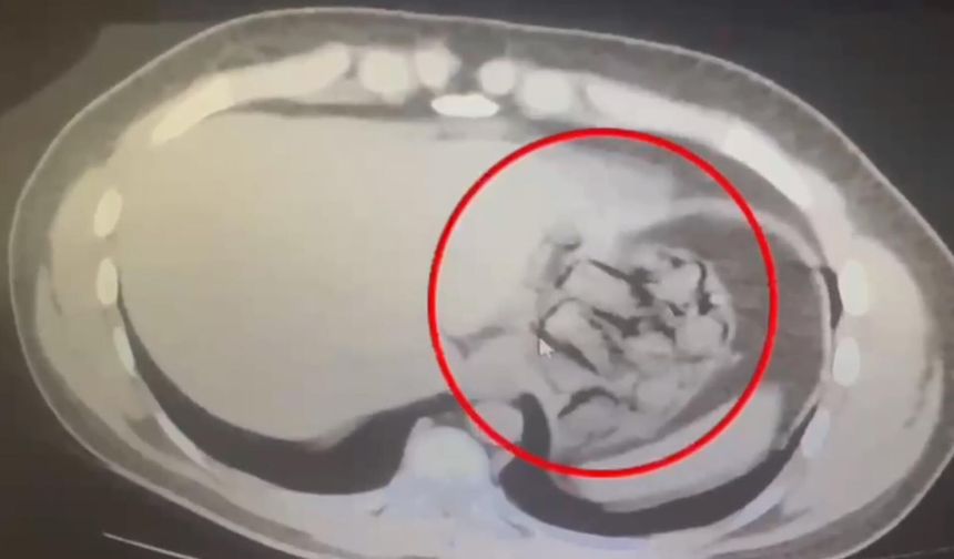 Midesinden 76 parça halinde 571 gram metamfetamin çıkarıldı